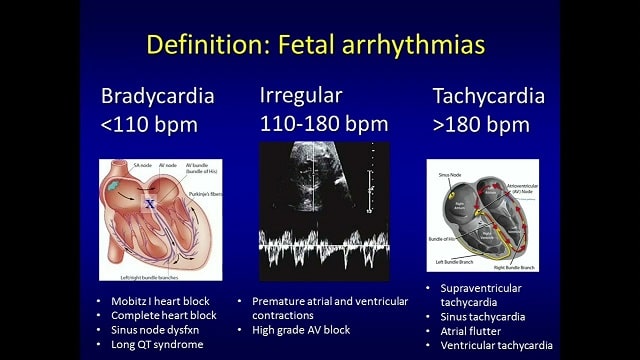 Fetal Arrhythmia