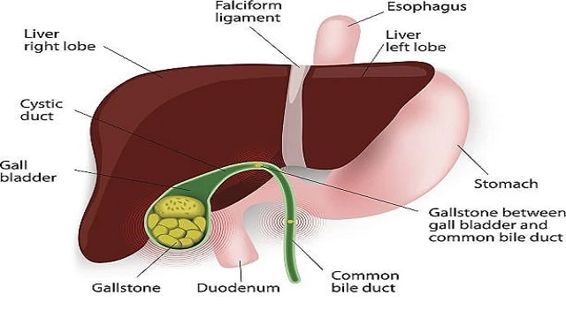 Gallstones