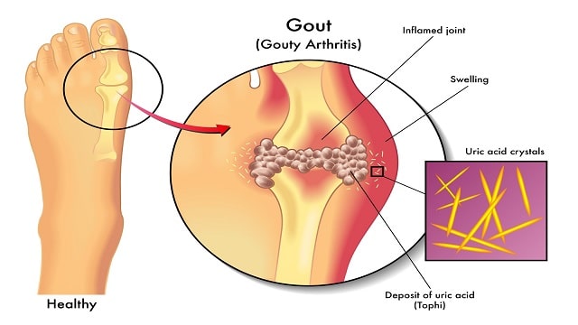 Gout Arthritis