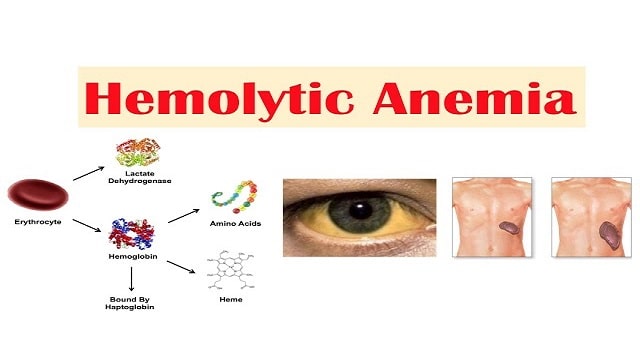 Hemolytic Anemia