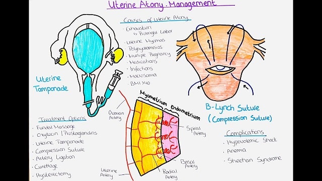 Uterine Atony