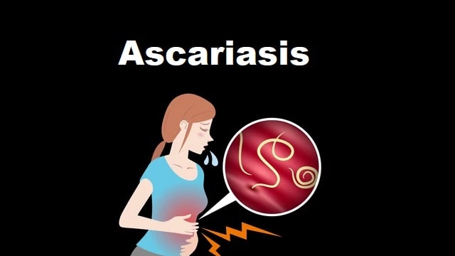 Ascariasis