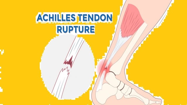 Achilles Tendon Injury