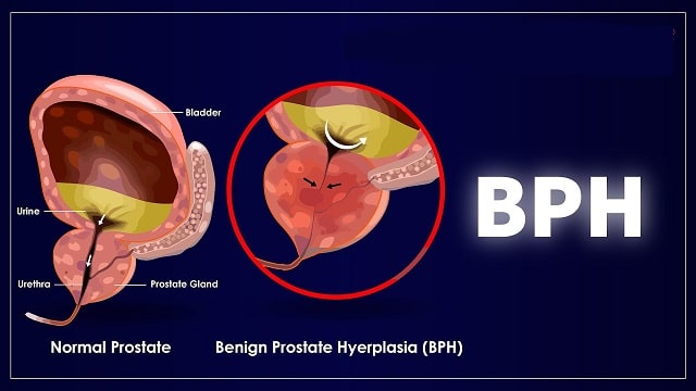 BPH (Benign Prostatic Hyperplasia)