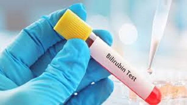 Bilirubin Total Check