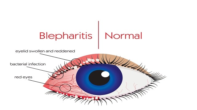 Blepharitis