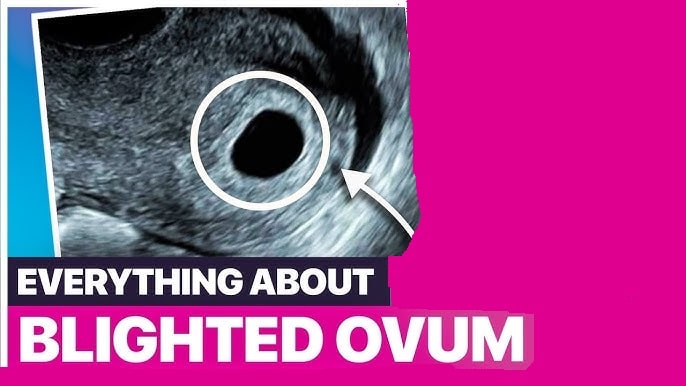 Blighted Ovum