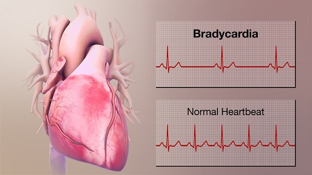 Bradycardia