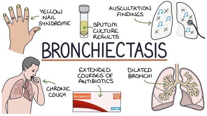 Bronchiectasis