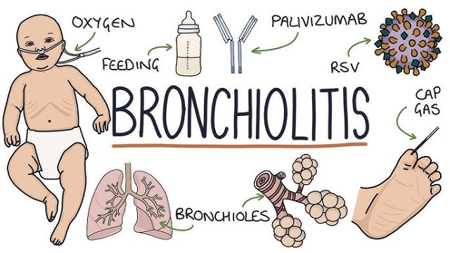 Bronchiolitis