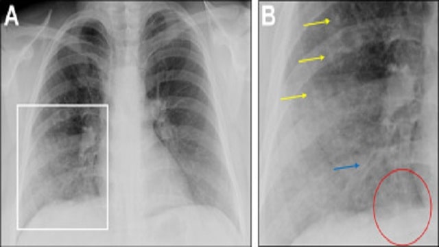 Bronchopneumonia