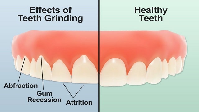 Bruxism