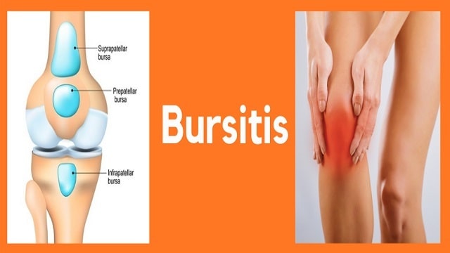 Bursitis