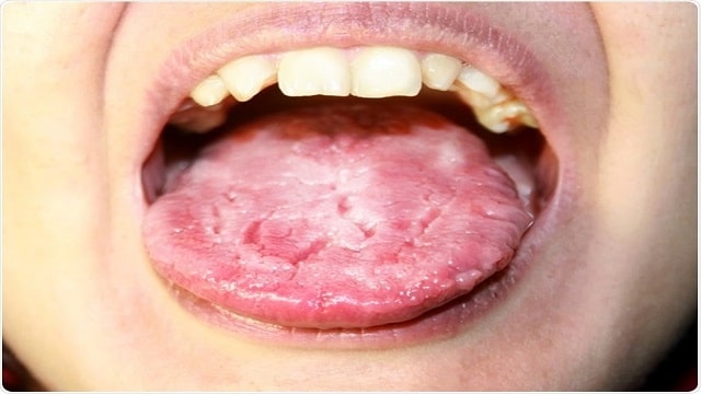 Candidiasis