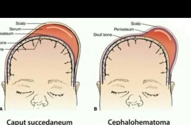 Caput Succedaneum