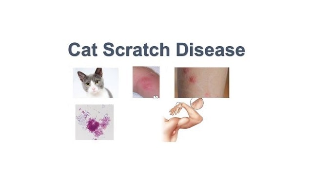 Cat Scratch Disease