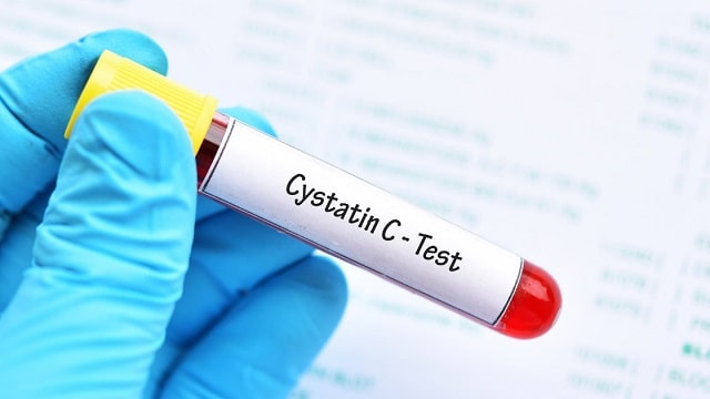 Cystatin C Check