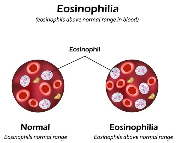 Eosinophil Count