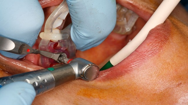 Oral Surgery