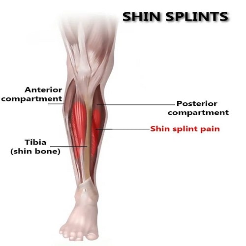 Shin Splints