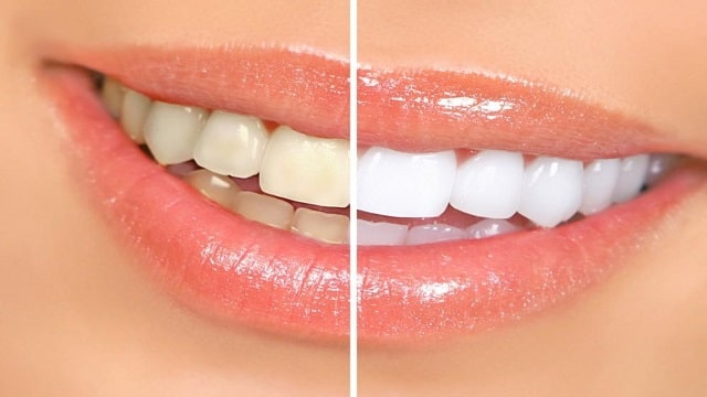 Teeth Bleaching