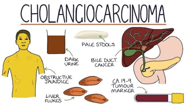 Cholangiocarcinoma