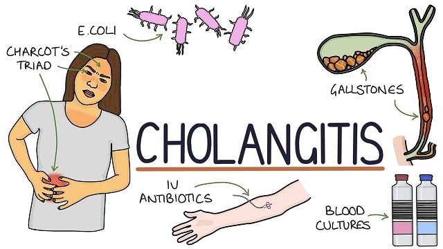 Cholangitis