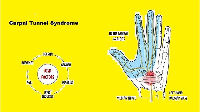 Carpal Tunnel Syndrome