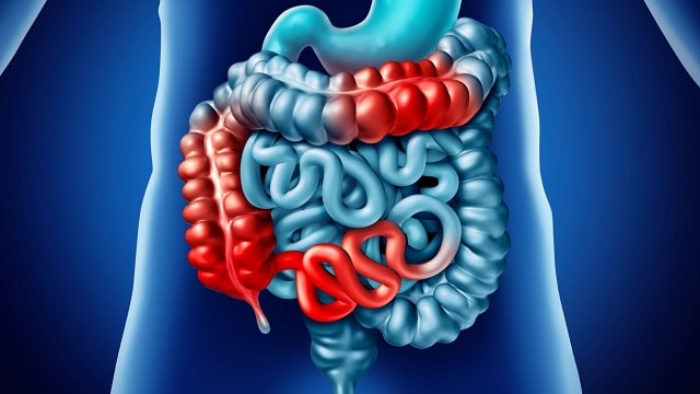 Crohn's Disease