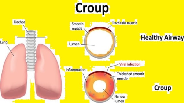 Croup Symptoms