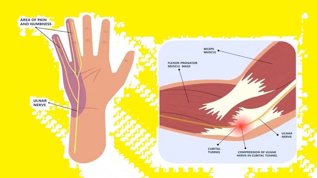 Cubital Tunnel Syndrome