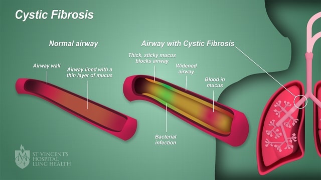 Cystic Fibrosis