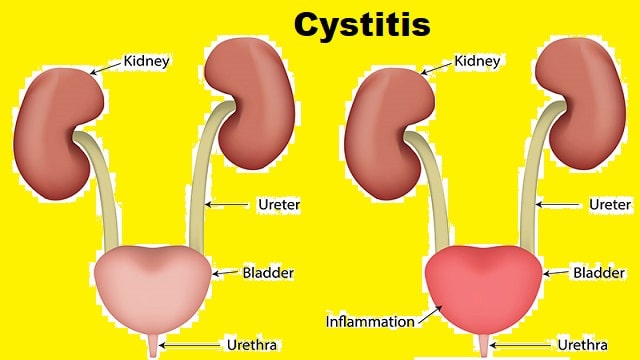 Cystitis